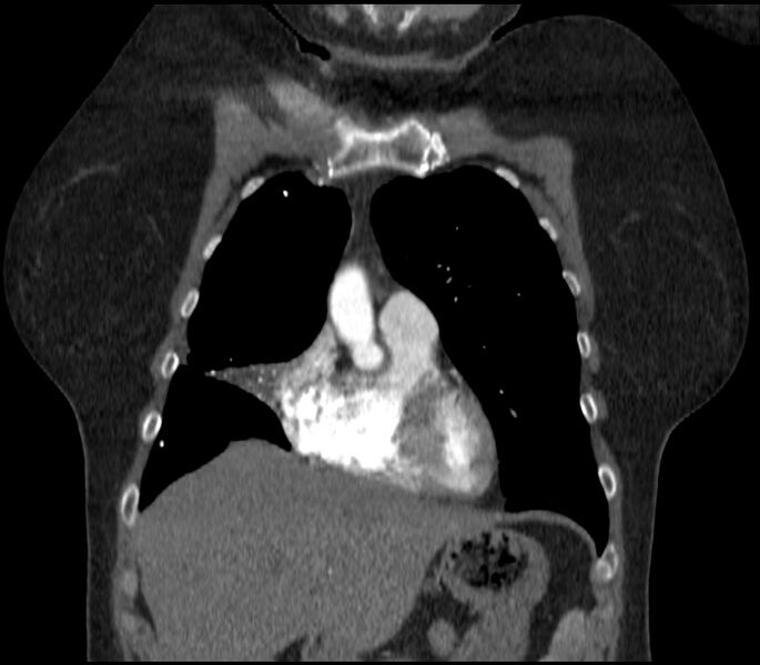 File:Adenocarcinoma of the lung (Radiopaedia 44205-47803 Coronal C+ portal venous phase 22).jpg