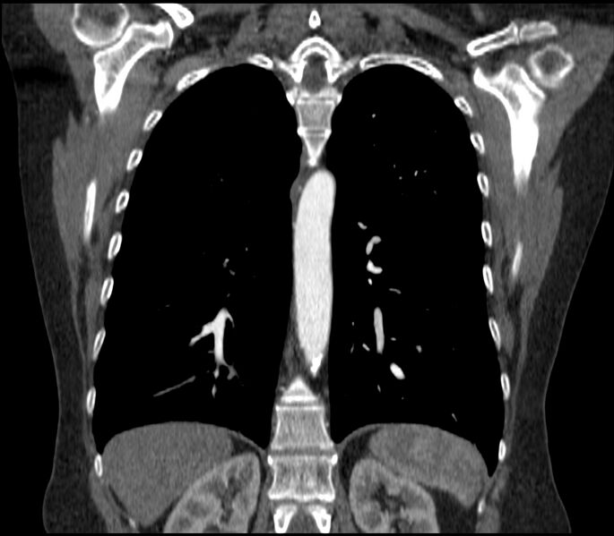 File:Adenocarcinoma of the lung (Radiopaedia 44205-47803 Coronal C+ portal venous phase 65).jpg