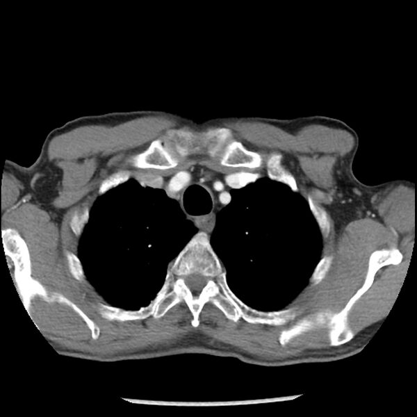 File:Adenocarcinoma of the lung - micropapillary predominant (Radiopaedia 42446-45563 Axial C+ portal venous phase 11).jpg
