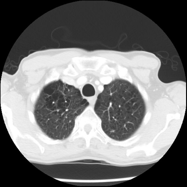 File:Adenocarcinoma of the lung - micropapillary predominant (Radiopaedia 42446-45563 Axial lung window 12).jpg