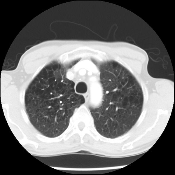 File:Adenocarcinoma of the lung - micropapillary predominant (Radiopaedia 42446-45563 Axial lung window 17).jpg