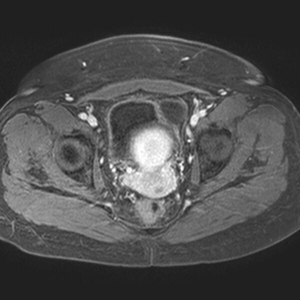 File:Adenomyoma of the uterus (Radiopaedia 9871-10439 Axial T1 C+ fat sat 9).jpg