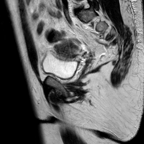 File:Adenomyoma of the uterus (Radiopaedia 9871-10439 Sagittal T2 18).jpg