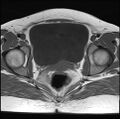 Adenomyosis - ovarian endometriomas (Radiopaedia 67031-76350 Axial T1 20).jpg