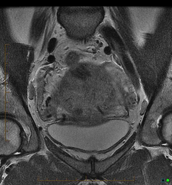 File:Adenomyosis uterus with hematometra (Radiopaedia 45779-50011 Coronal T2 6).jpg