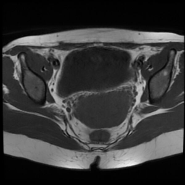 File:Adenomyosis within a septate uterus (Radiopaedia 69963-79981 Axial T1 17).jpg