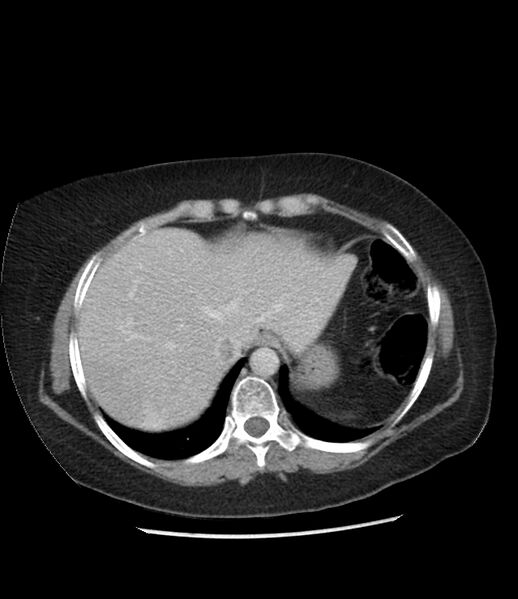 File:Adrenal cortical carcinoma with IVC invasion and thrombosis (Radiopaedia 34307-35597 Axial C+ portal venous phase 12).jpg