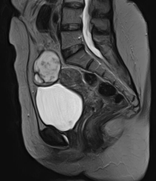 File:Adult granulosa cell tumor of the ovary (Radiopaedia 71581-81950 Sagittal T2 12).jpg