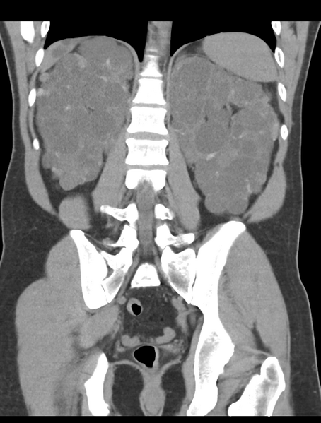 File:Adult polycystic kidney disease (Radiopaedia 47866-52626 Coronal non-contrast 35).png
