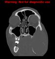 Ameloblastoma (Radiopaedia 13276-13280 Coronal non-contrast 8).jpg