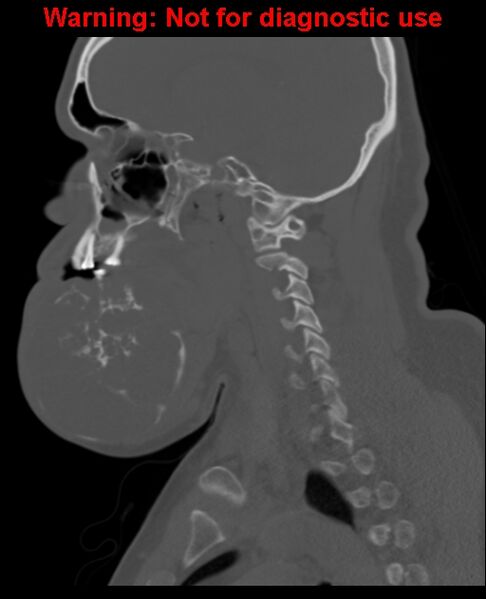 File:Ameloblastoma (Radiopaedia 33126-34164 Sagittal bone window 34).jpg