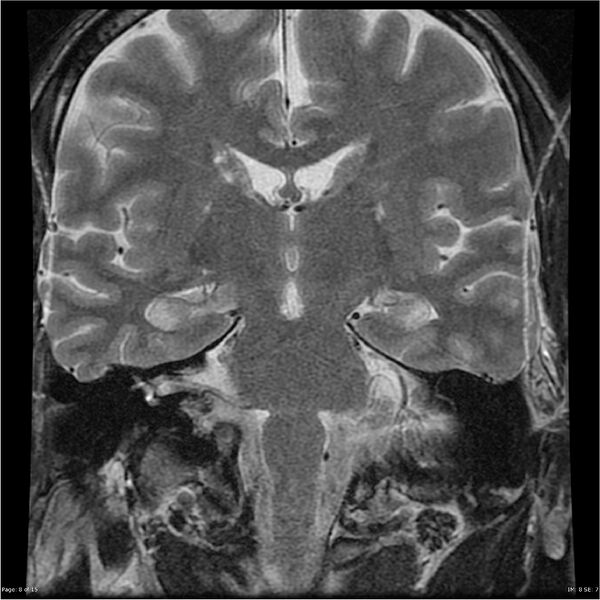 File:Amnestic syndrome secondary to hypoxic brain injury (Radiopaedia 24743-25004 F 8).jpg