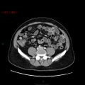 Ampullary carcinoma (Radiopaedia 56396-63056 C 65).jpg