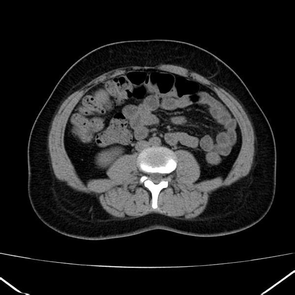 File:Ampullary tumor (Radiopaedia 22787-22816 Axial non-contrast 31).jpg