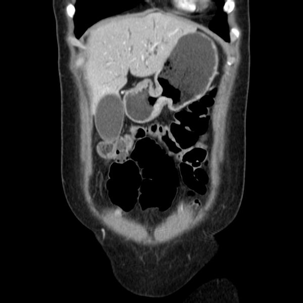 File:Ampullary tumor (Radiopaedia 22787-22816 E 13).jpg