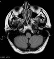 Amyotrophic lateral sclerosis (Radiopaedia 5373-7134 Axial FLAIR 5).jpg