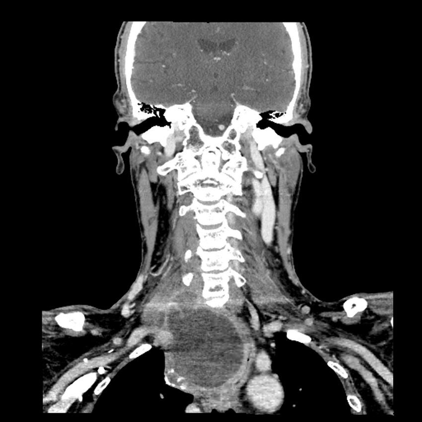 Anaplastic thyroid carcinoma (Radiopaedia 79087-92034 A 72).jpg