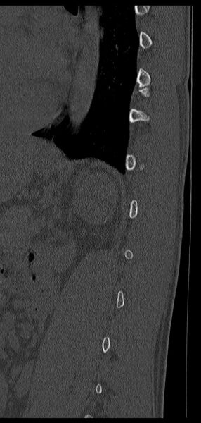 File:Aneurysmal bone cyst T11 (Radiopaedia 29294-29721 Sagittal bone window 18).jpg