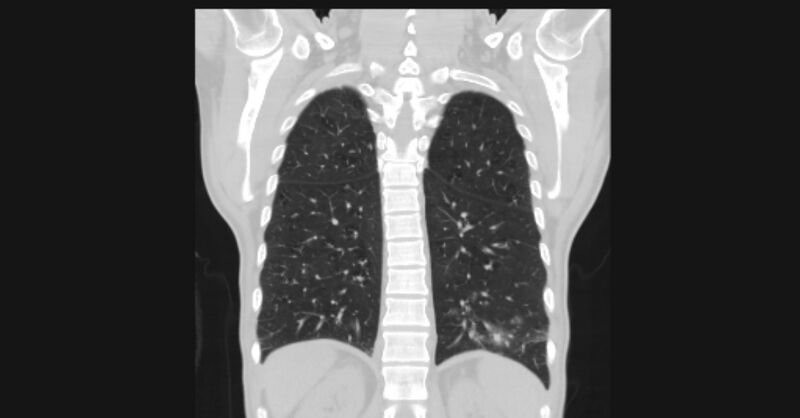 File:Angioinvasive aspergellosis (Radiopaedia 66995-76315 Coronal lung window 48).jpg