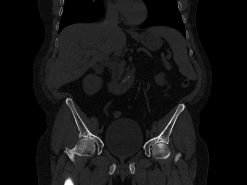 File:Ankylosing spondylitis (Radiopaedia 44609-48357 Coronal bone window 18).jpg
