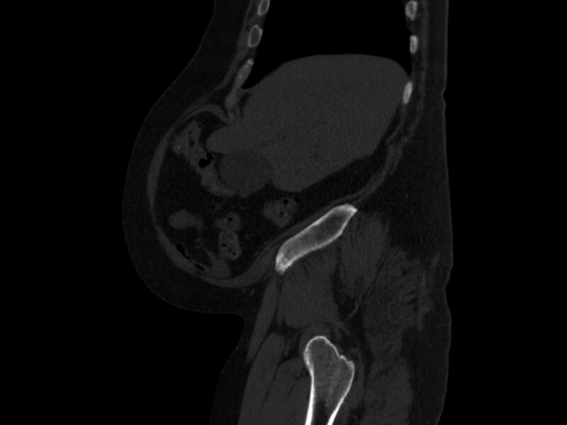 File:Ankylosing spondylitis (Radiopaedia 44609-48357 Sagittal bone window 10).jpg