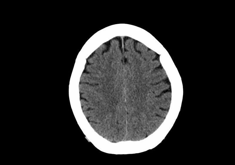 File:Anomalous intracranial venous drainage (Radiopaedia 28161-28418 Axial non-contrast 33).jpg