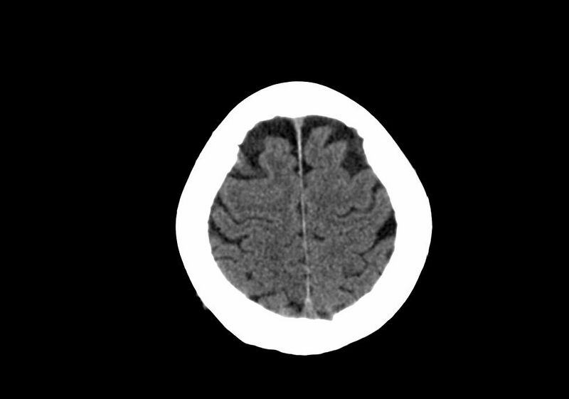 File:Anomalous intracranial venous drainage (Radiopaedia 28161-28418 Axial non-contrast 38).jpg