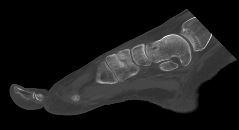 File:Anterior calcaneal process fracture (Radiopaedia 47384-51989 Sagittal bone window 21).png