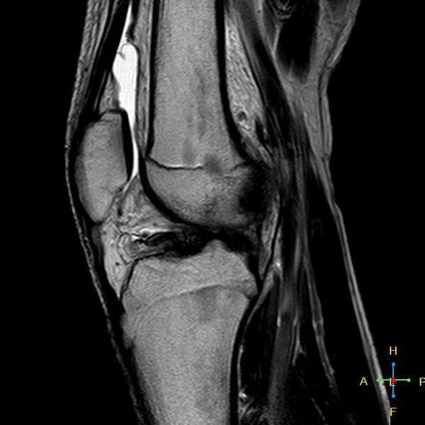 File:Anterior cruciate ligament tear - complete (Radiopaedia 24907-25170 Sagittal T2 8).jpg