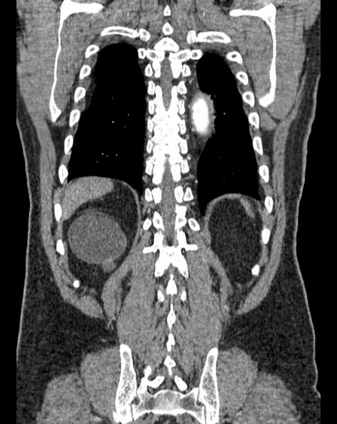 File:Aortic dissection (Radiopaedia 44411-48061 A 58).jpg