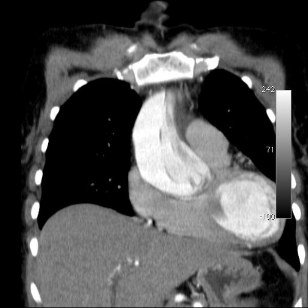 File:Aortic dissection - Stanford type A (Radiopaedia 29247-29659 B 20).jpg