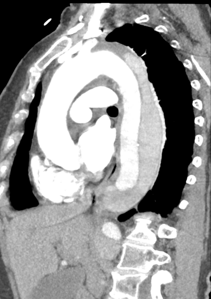 File:Aortic dissection - Stanford type B (Radiopaedia 50171-55512 C 27).png