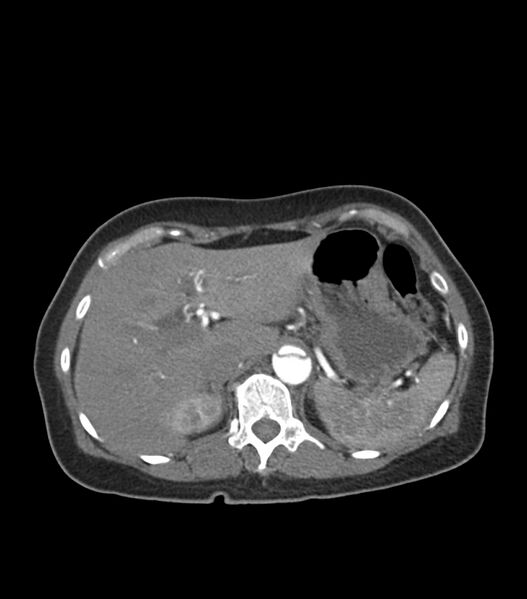 File:Aortic dissection with renal ischemia (Radiopaedia 76573-88338 A 59).jpg