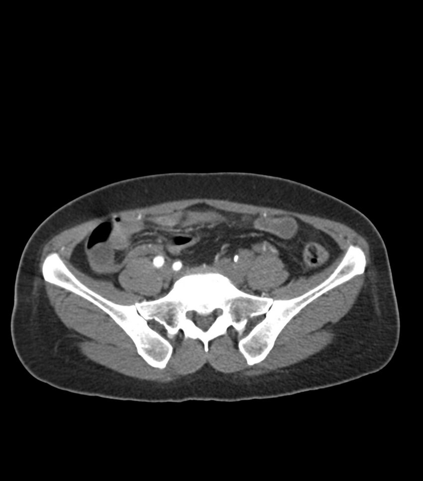 Aortic dissection with renal ischemia (Radiopaedia 76573-88338 A 92).jpg