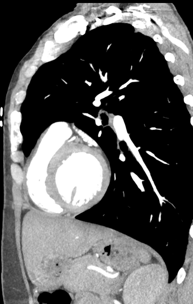 File:Aortic valve non-coronary cusp thrombus (Radiopaedia 55661-62189 C+ arterial phase 17).png