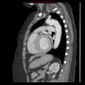 Aortic valve stenosis (Radiopaedia 14480-14423 B 11).jpg