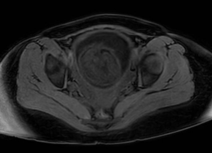 Appendicitis in gravida (MRI) (Radiopaedia 89433-106395 Axial DIXON 131).jpg