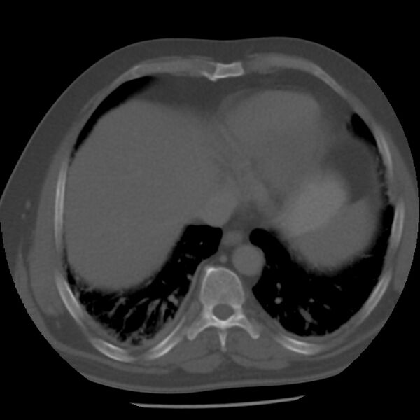 File:Appendicitis with perforation (Radiopaedia 35790-37342 Axial bone window 4).jpg