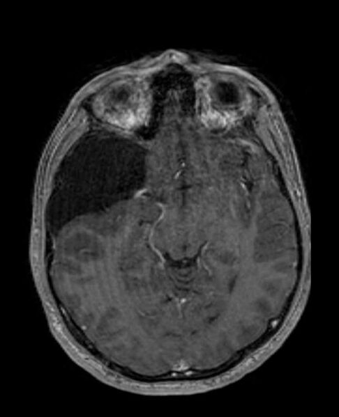 File:Arachnoid cyst- extremely large (Radiopaedia 68741-78451 Axial T1 C+ 36).jpg
