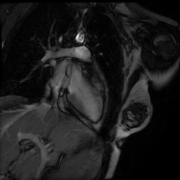 File:Arrhythmogenic right ventricular cardiomyopathy (Radiopaedia 87505-103850 2ch (LV) Cine SSFP 4).jpg