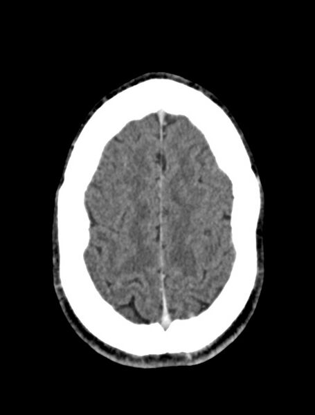 File:Arrow injury to the face (Radiopaedia 73267-84011 Axial C+ delayed 71).jpg