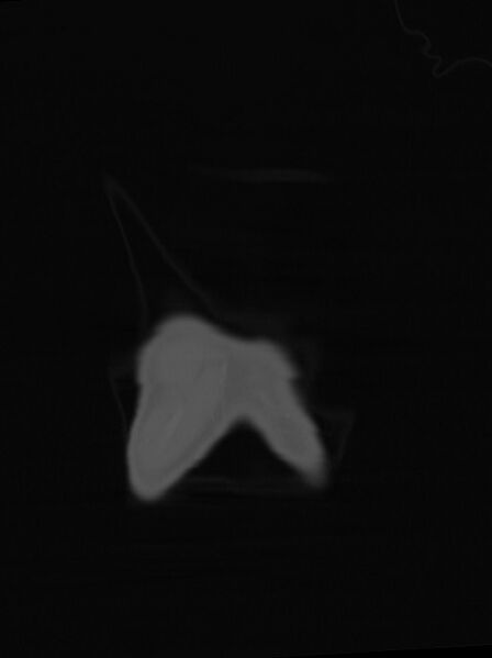 File:Arrow injury to the neck (Radiopaedia 75225-86323 Coronal bone window 5).jpg