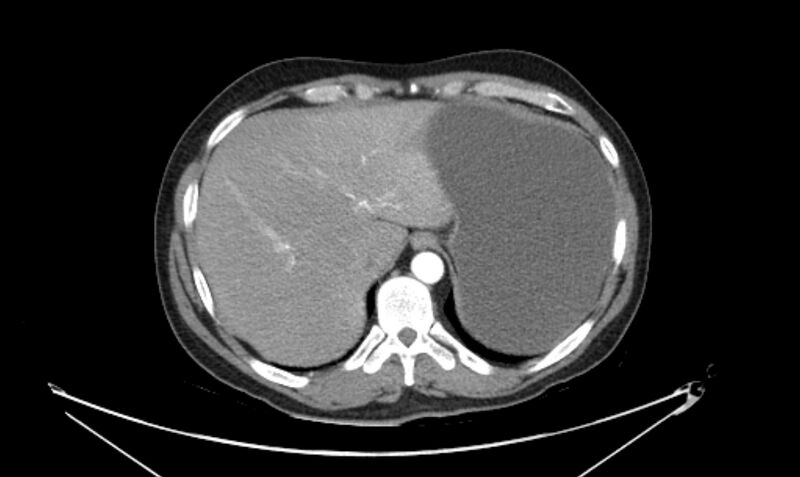 File:Arterial occlusive mesenteric ischemia (Radiopaedia 84641-100060 A 27).jpg