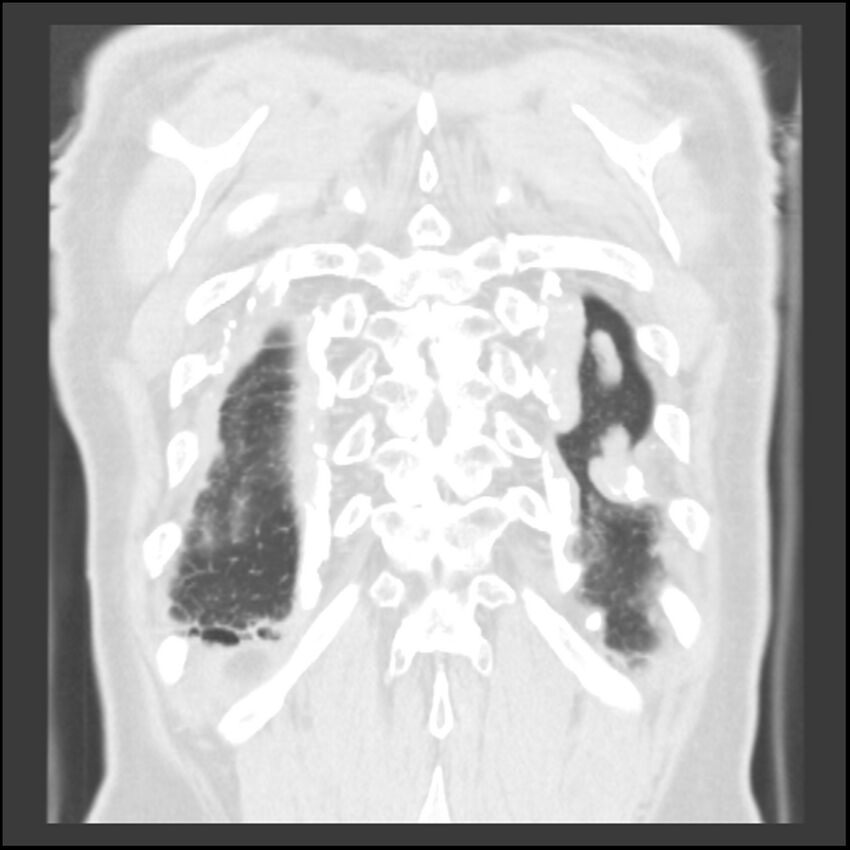 Asbestos-related pleural plaques (Radiopaedia 39069-41255 Coronal lung window 9).jpg