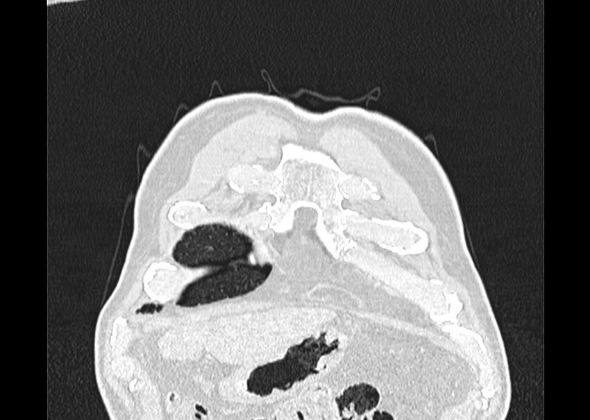 Asbestos pleural placques (Radiopaedia 57905-64872 Coronal lung window 10).jpg