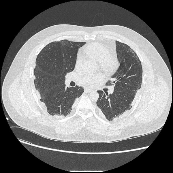 File:Asbestosis (Radiopaedia 45002-48961 Axial lung window 26).jpg