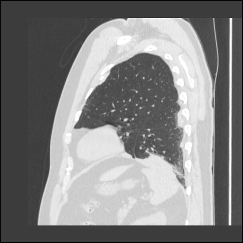 Asbestosis (Radiopaedia 45002-48961 Sagittal lung window 30).jpg