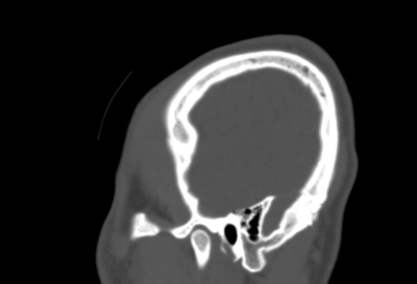Asymptomatic occipital spur (Radiopaedia 87753-104201 Sagittal bone window 284).jpg