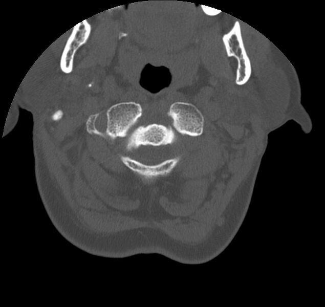 File:Atlanto-occipital assimilation with basilar invagination (Radiopaedia 70122-80188 Axial bone window 25).jpg