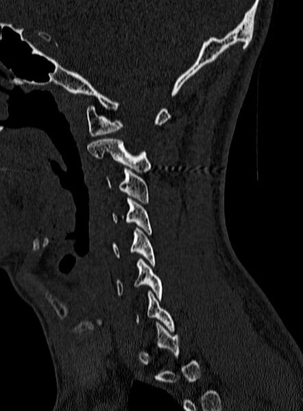 File:Atlantoaxial subluxation (Radiopaedia 44681-48450 Sagittal bone window 23).jpg